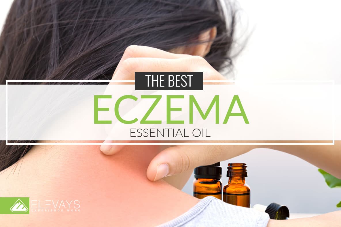 Essential Oils for Eczema